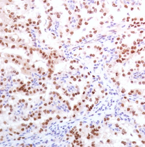 Immunohistochemistry (Formalin/PFA-fixed paraffin-embedded sections) - Anti-PAX8 antibody [SP348] - BSA and Azide free (AB242429), expandable thumbnail