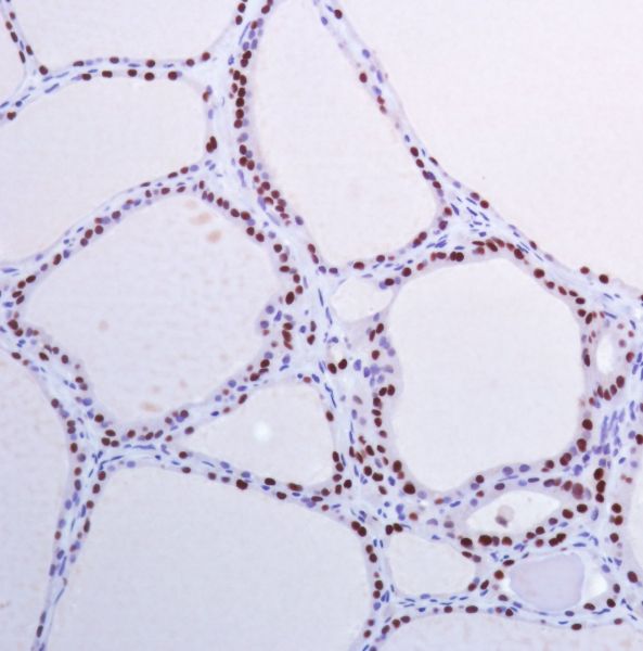 Immunohistochemistry (Formalin/PFA-fixed paraffin-embedded sections) - Anti-PAX8 antibody [SP348] - N-terminal (ab227707), expandable thumbnail