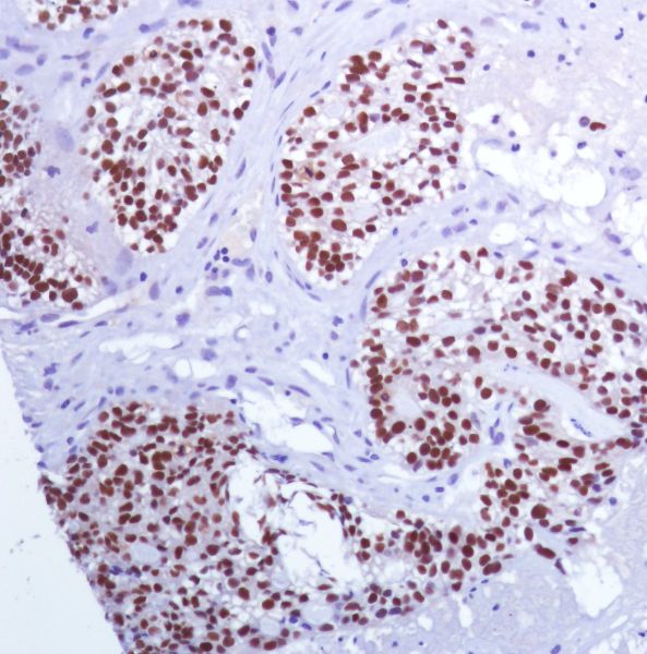 Immunohistochemistry (Formalin/PFA-fixed paraffin-embedded sections) - Anti-PAX8 antibody [SP348] - N-terminal (ab227707), expandable thumbnail