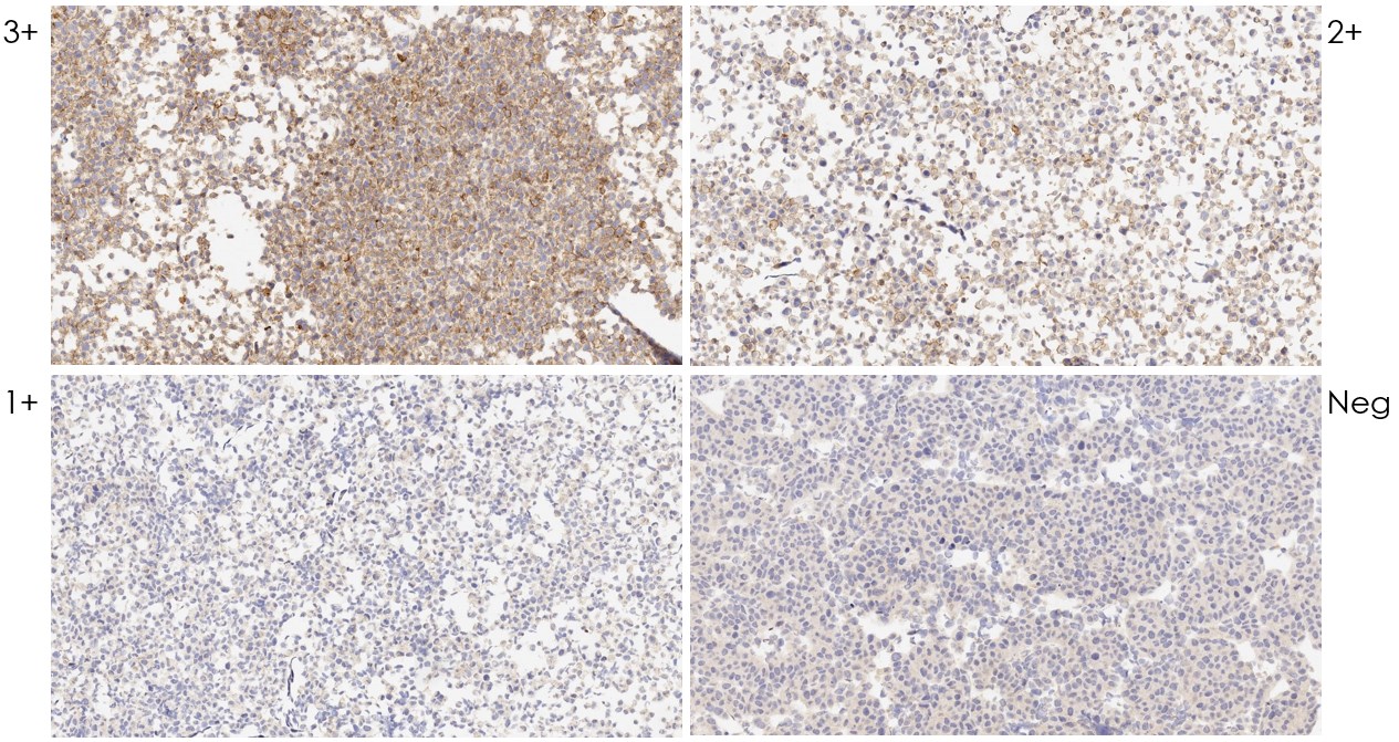 Immunohistochemistry (Formalin/PFA-fixed paraffin-embedded sections) - Anti-PD-L1 antibody [28-8] - Low endotoxin, Azide free (ab209889), expandable thumbnail