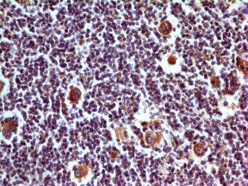 Immunohistochemistry (Formalin/PFA-fixed paraffin-embedded sections) - Anti-PD-L1 antibody [ABM4E54] (AB210931), expandable thumbnail