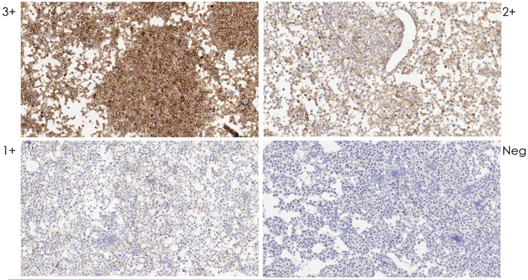 Immunohistochemistry (Formalin/PFA-fixed paraffin-embedded sections) - Anti-PD-L1 antibody [CAL10] (AB237726)