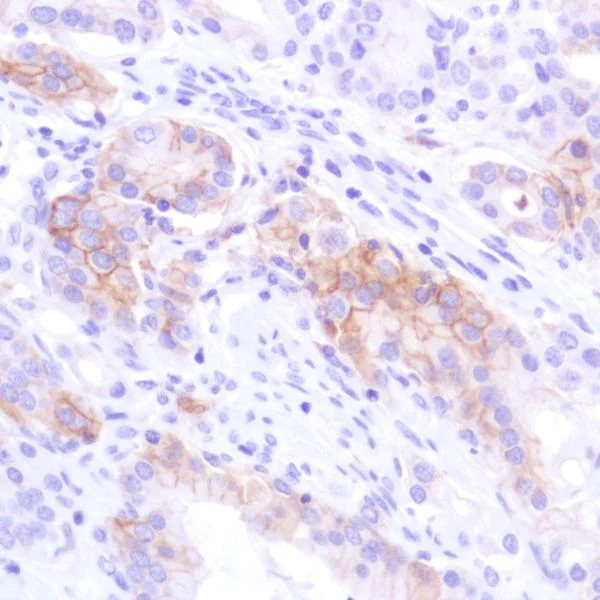 Immunohistochemistry (Formalin/PFA-fixed paraffin-embedded sections) - Anti-PD-L1 antibody [SP142] - C-terminal, BSA and Azide free (AB236238)