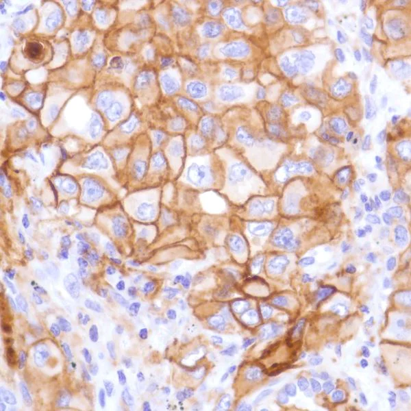 Immunohistochemistry (Formalin/PFA-fixed paraffin-embedded sections) - Anti-PD-L1 antibody [SP142] - C-terminal, BSA and Azide free (AB236238)