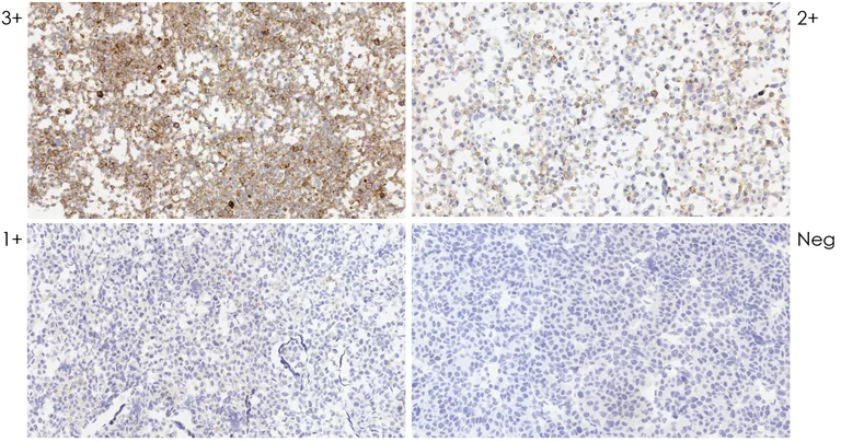 Immunohistochemistry (Formalin/PFA-fixed paraffin-embedded sections) - Anti-PD-L1 antibody [SP142] - C-terminal, BSA and Azide free (AB236238)