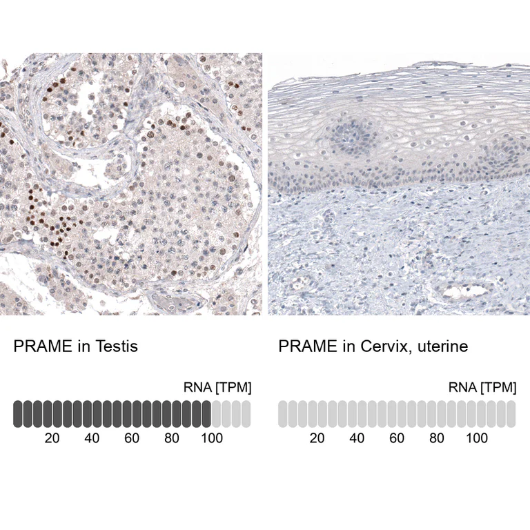 Immunohistochemistry (Formalin/PFA-fixed paraffin-embedded sections) - Anti-PRAME Antibody [CL5148] (AB327118)