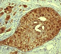 Immunohistochemistry (Formalin/PFA-fixed paraffin-embedded sections) - Anti-proCathepsin D antibody [EPR3054] (ab134169), expandable thumbnail