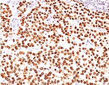 Immunohistochemistry (Formalin/PFA-fixed paraffin-embedded sections) - Anti-Progesterone Receptor antibody [PR484] (AB187294), expandable thumbnail