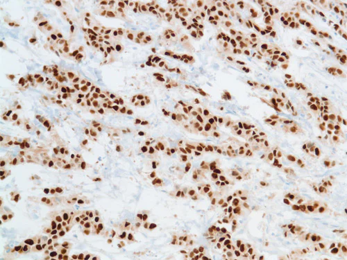 Immunohistochemistry (Formalin/PFA-fixed paraffin-embedded sections) - Anti-Progesterone Receptor antibody [SP2] (AB16661)