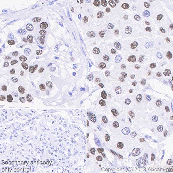 Immunohistochemistry (Formalin/PFA-fixed paraffin-embedded sections) - Anti-Progesterone Receptor antibody [SP42] (AB101688), expandable thumbnail