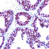 Immunohistochemistry (Formalin/PFA-fixed paraffin-embedded sections) - Anti-Progesterone Receptor antibody [SP42] (ab101688), expandable thumbnail
