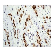 Immunohistochemistry (Formalin/PFA-fixed paraffin-embedded sections) - Anti-Progesterone Receptor antibody [YR85] (AB32085), expandable thumbnail