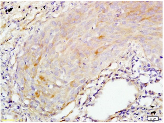 Immunohistochemistry (Formalin/PFA-fixed paraffin-embedded sections) - Anti-Psoriasin antibody (AB218207), expandable thumbnail