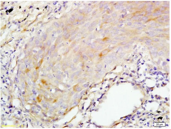 Immunohistochemistry (Formalin/PFA-fixed paraffin-embedded sections) - Anti-Psoriasin antibody (AB218207)