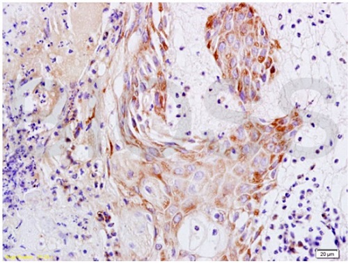 Immunohistochemistry (Formalin/PFA-fixed paraffin-embedded sections) - Anti-Psoriasin antibody (AB218207), expandable thumbnail