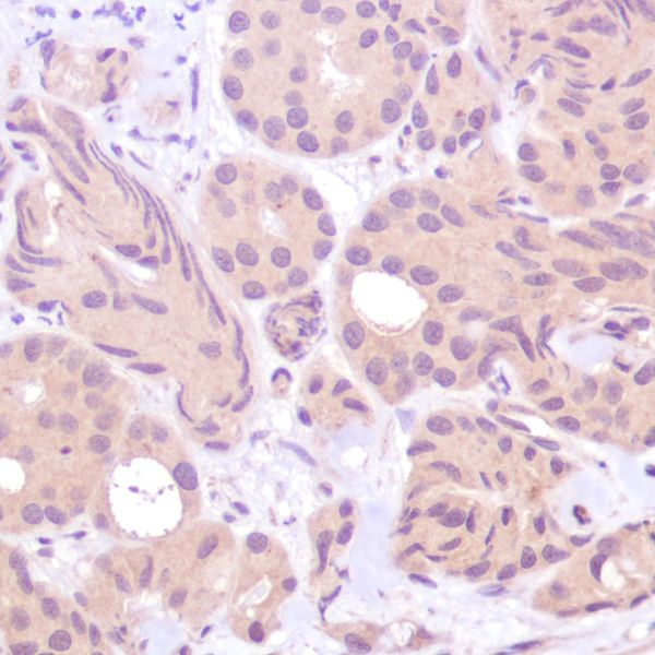 Immunohistochemistry (Formalin/PFA-fixed paraffin-embedded sections) - Anti-PTEN antibody [SP170] - BSA and Azide free (AB272009), expandable thumbnail