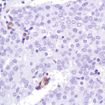 Immunohistochemistry (Formalin/PFA-fixed paraffin-embedded sections) - Anti-PTEN antibody [SP218] - BSA and Azide free (ab243940), expandable thumbnail