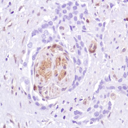 Immunohistochemistry (Formalin/PFA-fixed paraffin-embedded sections) - Anti-PTEN antibody [SP218] - BSA and Azide free (ab243940), expandable thumbnail