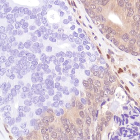 Immunohistochemistry (Formalin/PFA-fixed paraffin-embedded sections) - Anti-PTEN antibody [SP218] - BSA and Azide free (ab243940), expandable thumbnail