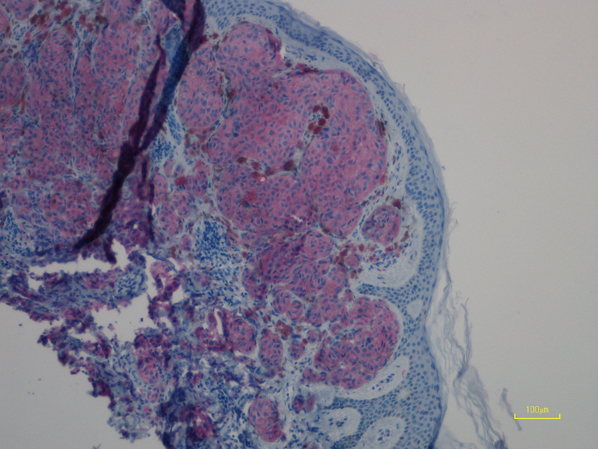 Immunohistochemistry (Formalin/PFA-fixed paraffin-embedded sections) - Anti-Ras (mutated Q61R) antibody [SP174] (AB227658), expandable thumbnail