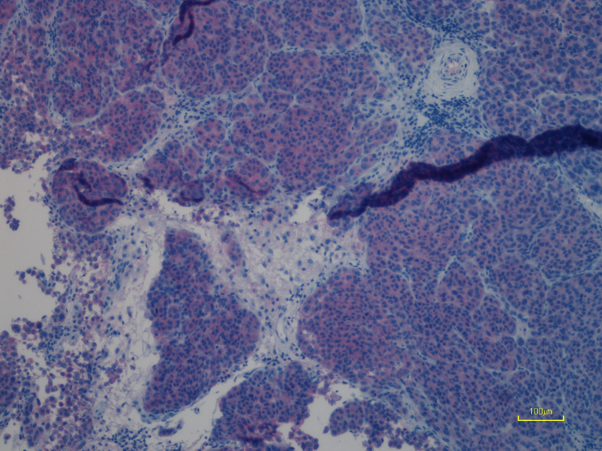 Immunohistochemistry (Formalin/PFA-fixed paraffin-embedded sections) - Anti-Ras (mutated Q61R) antibody [SP174] (AB227658), expandable thumbnail