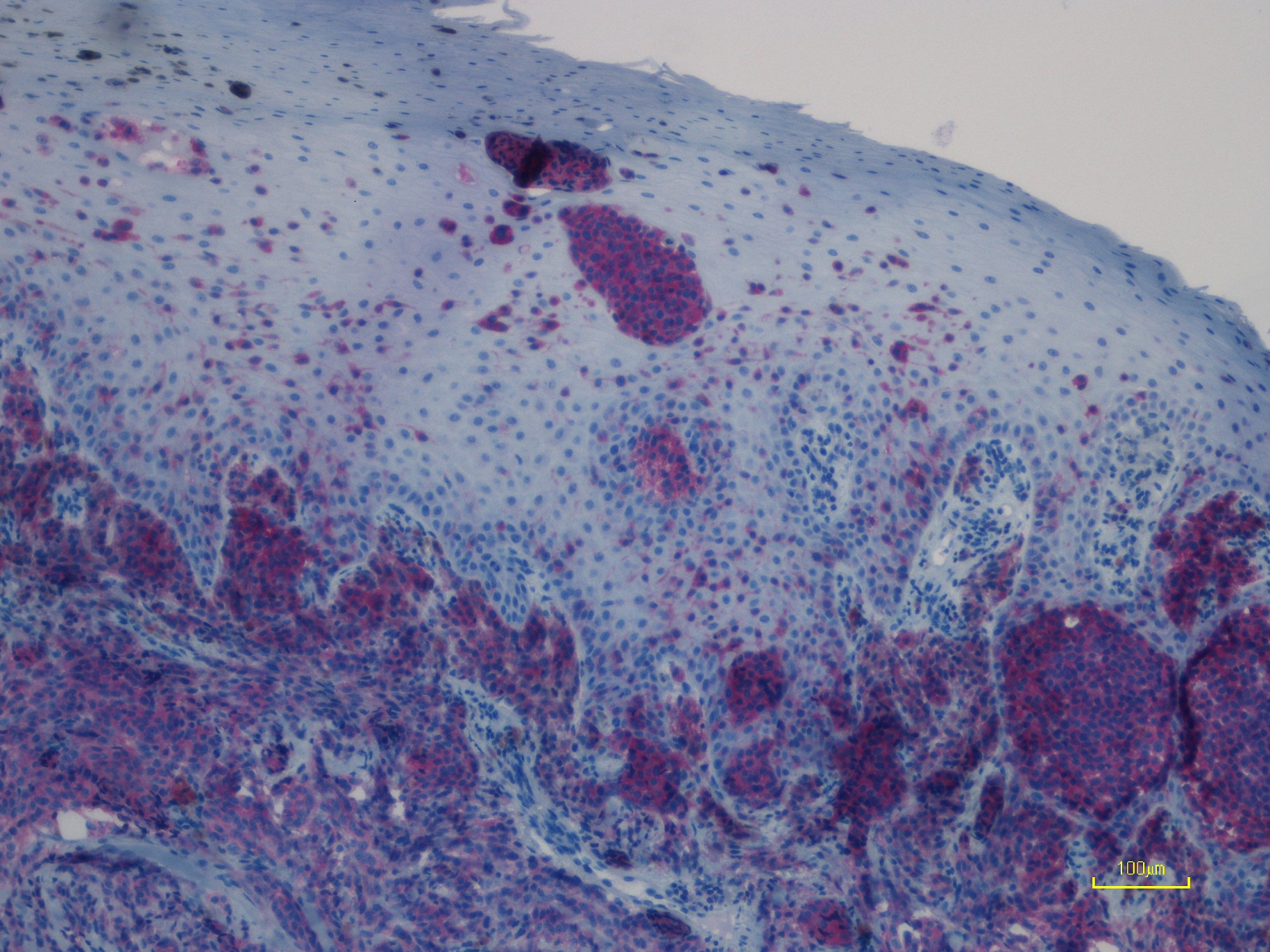 Immunohistochemistry (Formalin/PFA-fixed paraffin-embedded sections) - Anti-Ras (mutated Q61R) antibody [SP174] (AB227658), expandable thumbnail
