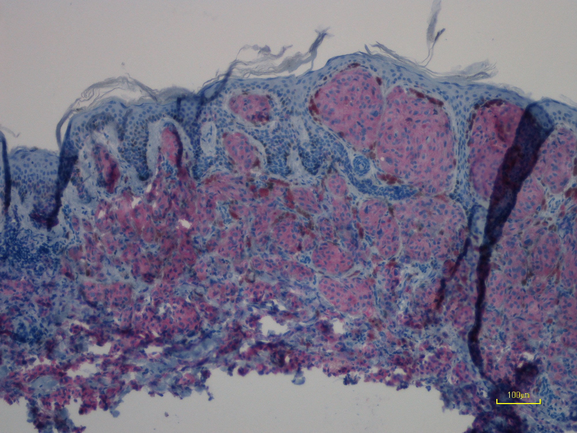 Immunohistochemistry (Formalin/PFA-fixed paraffin-embedded sections) - Anti-Ras (mutated Q61R) antibody [SP174] (AB227658), expandable thumbnail