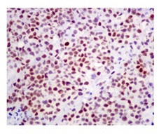 Immunohistochemistry (Formalin/PFA-fixed paraffin-embedded sections) - Anti-Rb (phospho S608) antibody [EPR10849] (AB172975), expandable thumbnail