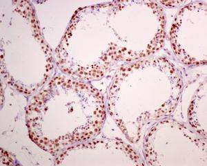 Immunohistochemistry (Formalin/PFA-fixed paraffin-embedded sections) - Anti-Rb (phospho S780) antibody [EPR182(N)] (ab173289), expandable thumbnail