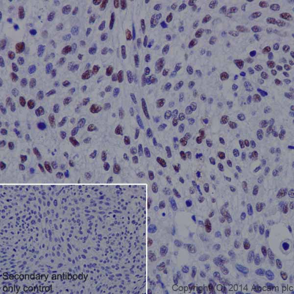 Immunohistochemistry (Formalin/PFA-fixed paraffin-embedded sections) - Anti-Rb (phospho T252) antibody [EPR17733] (AB184797), expandable thumbnail