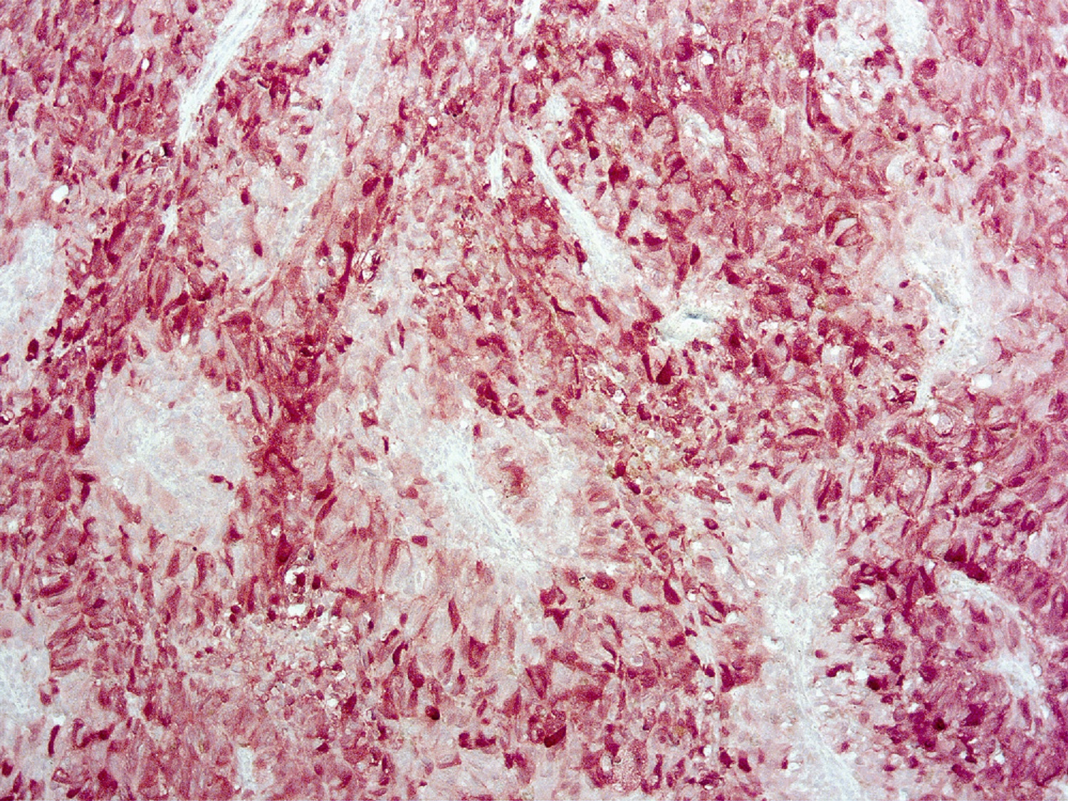 Immunohistochemistry (Formalin/PFA-fixed paraffin-embedded sections) - Anti-S100 antibody [4C4.9] (AB4066), expandable thumbnail