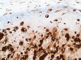 Immunohistochemistry (Formalin/PFA-fixed paraffin-embedded sections) - Anti-S100 beta antibody [SP127] (ab115803), expandable thumbnail
