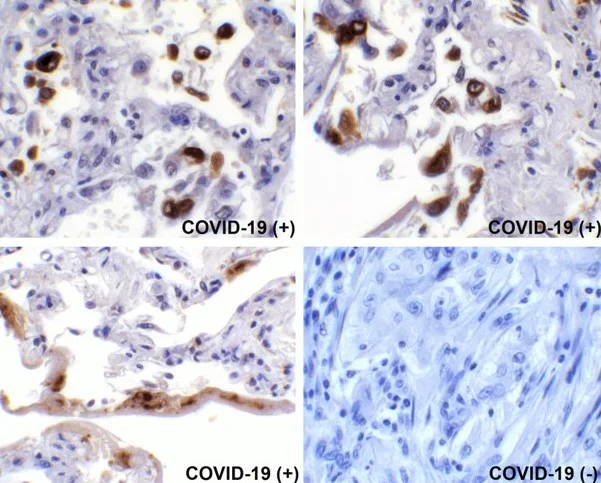 Immunohistochemistry (Formalin/PFA-fixed paraffin-embedded sections) - Anti-SARS-CoV-2 spike glycoprotein antibody - Coronavirus (AB272504)