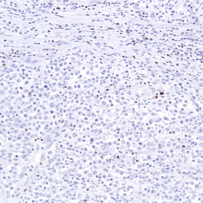 Immunohistochemistry (Formalin/PFA-fixed paraffin-embedded sections) - Anti-SATB1 antibody [SP287] - BSA and Azide free (AB272006), expandable thumbnail