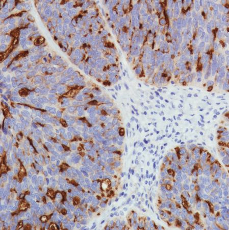 Immunohistochemistry (Formalin/PFA-fixed paraffin-embedded sections) - Anti-SLC34A2 antibody [SP322] - BSA and Azide free (AB238793), expandable thumbnail