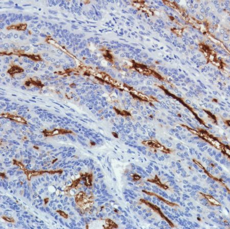 Immunohistochemistry (Formalin/PFA-fixed paraffin-embedded sections) - Anti-SLC34A2 antibody [SP322] - BSA and Azide free (ab238793), expandable thumbnail