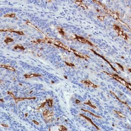 Immunohistochemistry (Formalin/PFA-fixed paraffin-embedded sections) - Anti-SLC34A2 antibody [SP322] - N-terminal (AB228474)