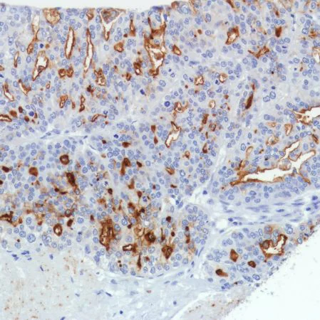 Immunohistochemistry (Formalin/PFA-fixed paraffin-embedded sections) - Anti-SLC34A2 antibody [SP322] - N-terminal (AB228474)