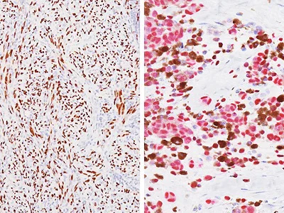 Immunohistochemistry (Formalin/PFA-fixed paraffin-embedded sections) - Anti-SOX10 antibody [BC34] (AB195364)