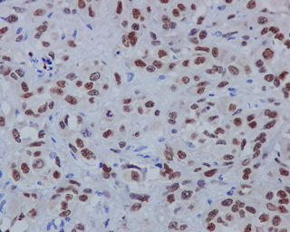 Immunohistochemistry (Formalin/PFA-fixed paraffin-embedded sections) - Anti-SOX10 antibody [EPR4007-104] (ab180862), expandable thumbnail