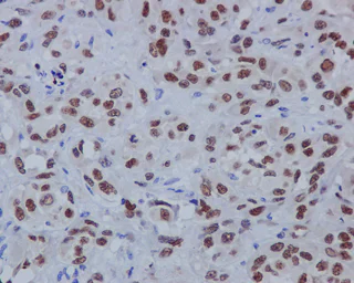 Immunohistochemistry (Formalin/PFA-fixed paraffin-embedded sections) - Anti-SOX10 antibody [EPR4007-104] - BSA and Azide free (AB220078)