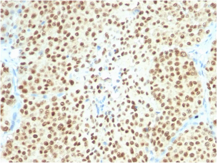 Immunohistochemistry (Formalin/PFA-fixed paraffin-embedded sections) - Anti-SOX10 antibody [SOX10/2311R] - BSA and Azide free (AB268234)