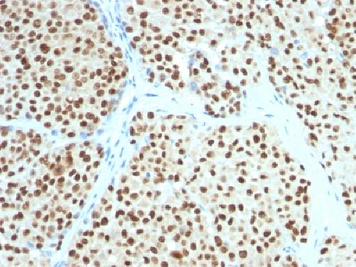 Immunohistochemistry (Formalin/PFA-fixed paraffin-embedded sections) - Anti-SOX10 antibody [SOX10/991] - BSA and Azide free (AB212843), expandable thumbnail