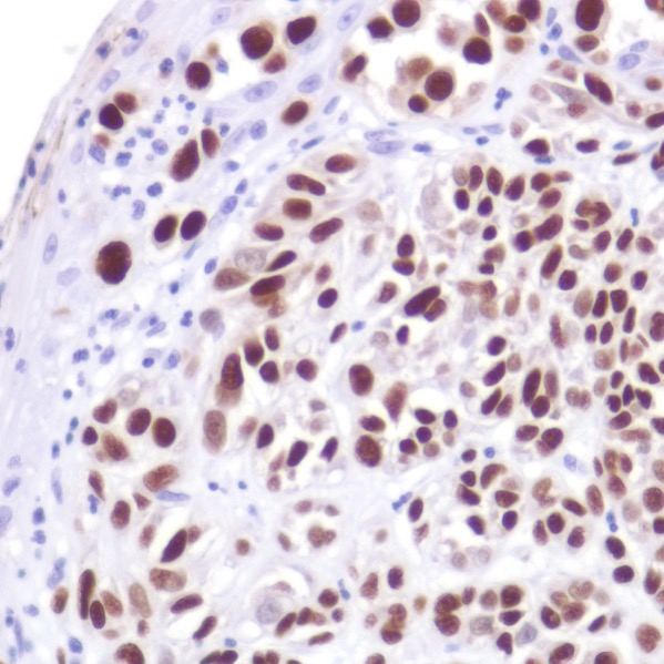 Immunohistochemistry (Formalin/PFA-fixed paraffin-embedded sections) - Anti-SOX10 antibody [SP267] - C-terminal, prediluted (AB228188)