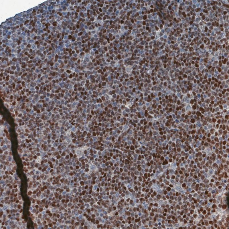 Immunohistochemistry (Formalin/PFA-fixed paraffin-embedded sections) - Anti-SOX11 antibody [CL0142] (AB154138)