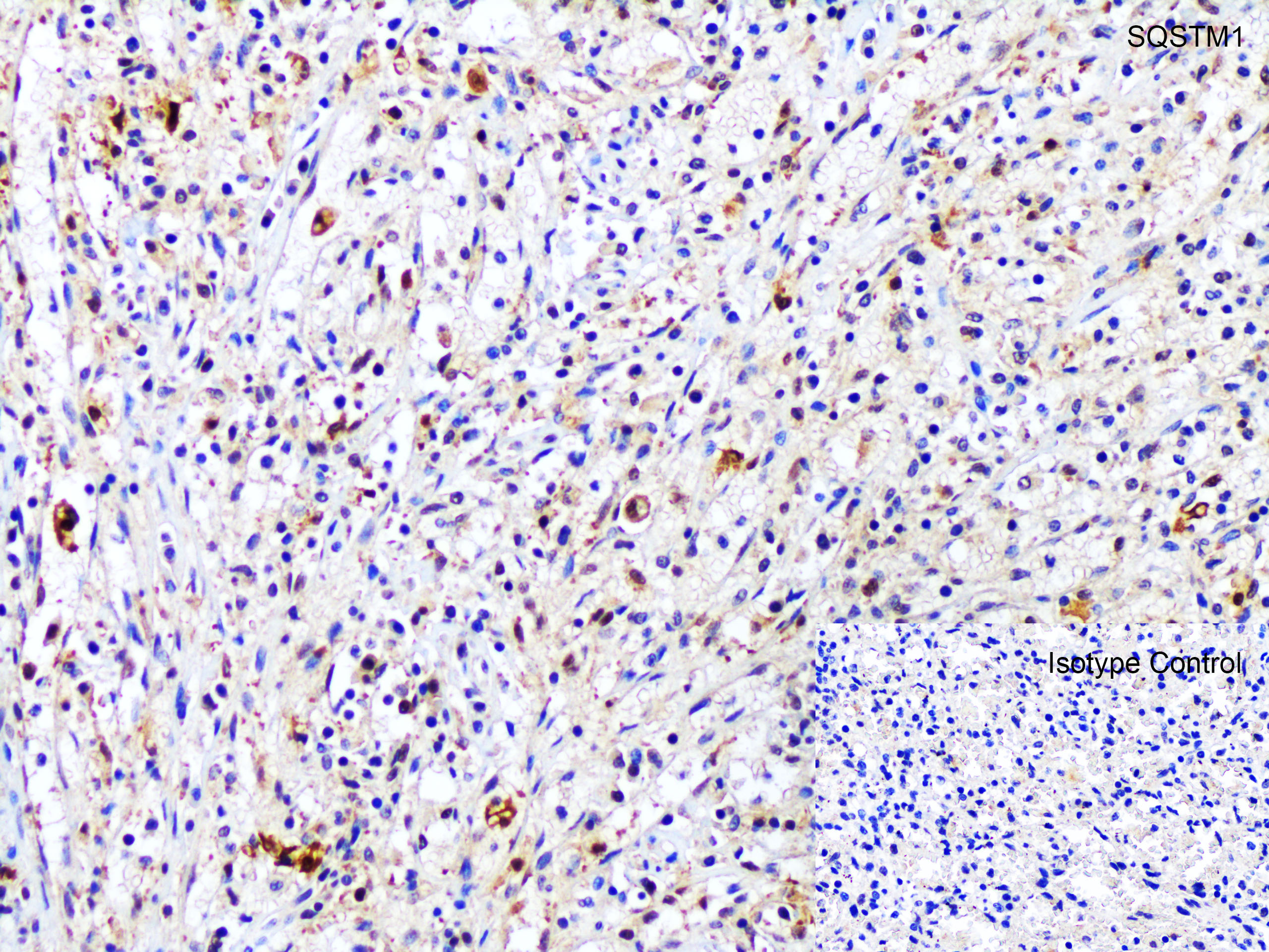 Immunohistochemistry (Formalin/PFA-fixed paraffin-embedded sections) - Anti-SQSTM1 / p62 antibody (ab91526), expandable thumbnail