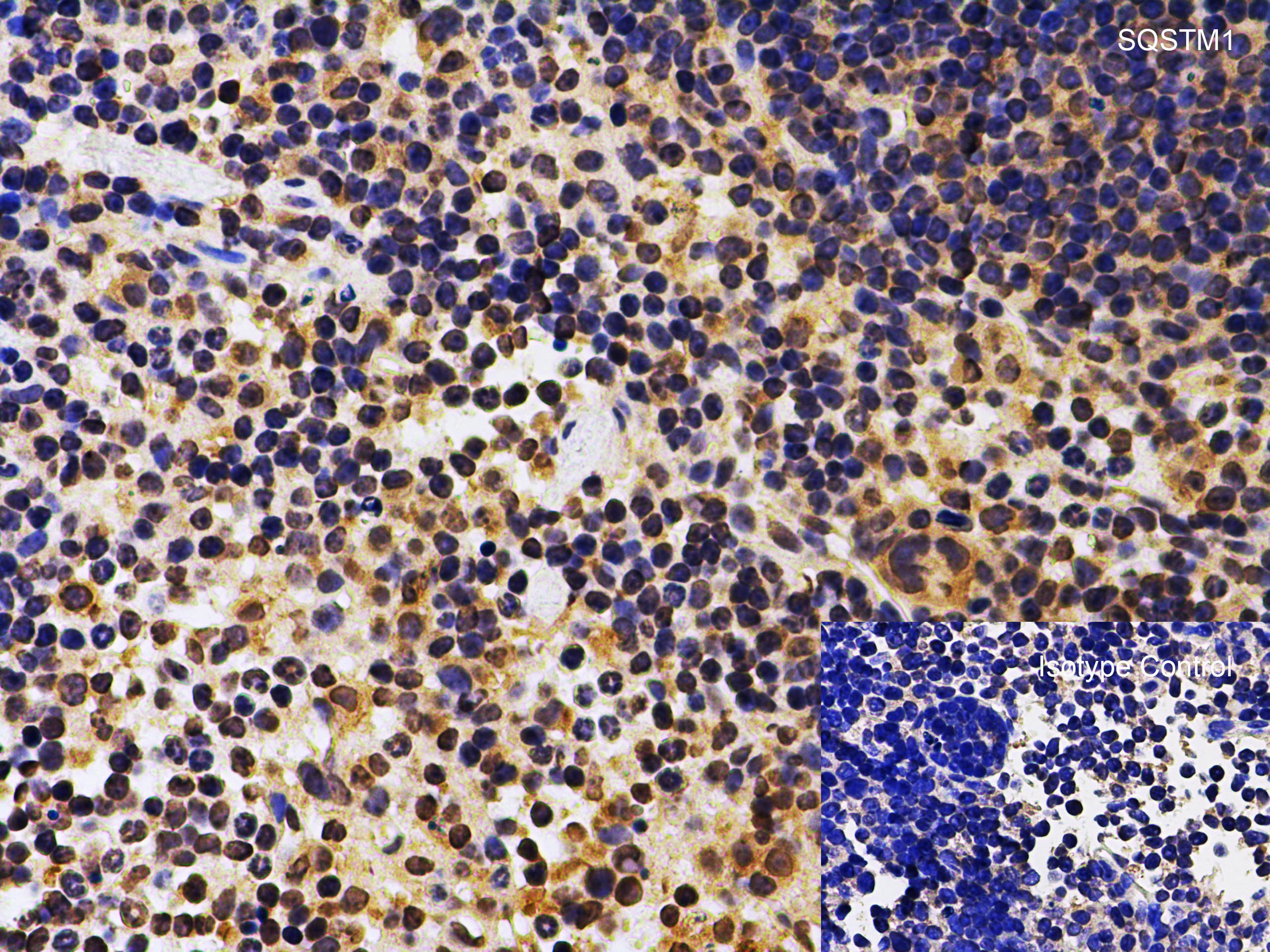 Immunohistochemistry (Formalin/PFA-fixed paraffin-embedded sections) - Anti-SQSTM1 / p62 antibody (ab91526), expandable thumbnail