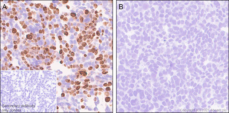 Immunohistochemistry (Formalin/PFA-fixed paraffin-embedded sections) - Anti-SS18-SSX Fusion Protein antibody [EPR24159-81] - BSA and Azide free (AB281565)