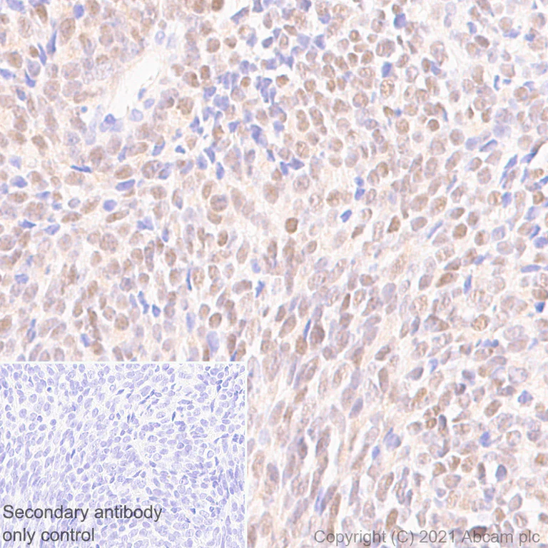 Immunohistochemistry (Formalin/PFA-fixed paraffin-embedded sections) - Anti-SS18-SSX Fusion Protein antibody [EPR24159-81] - BSA and Azide free (AB281565)