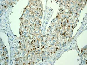 Immunohistochemistry (Formalin/PFA-fixed paraffin-embedded sections) - Anti-Survivin antibody [EP2880Y] (ab76424), expandable thumbnail